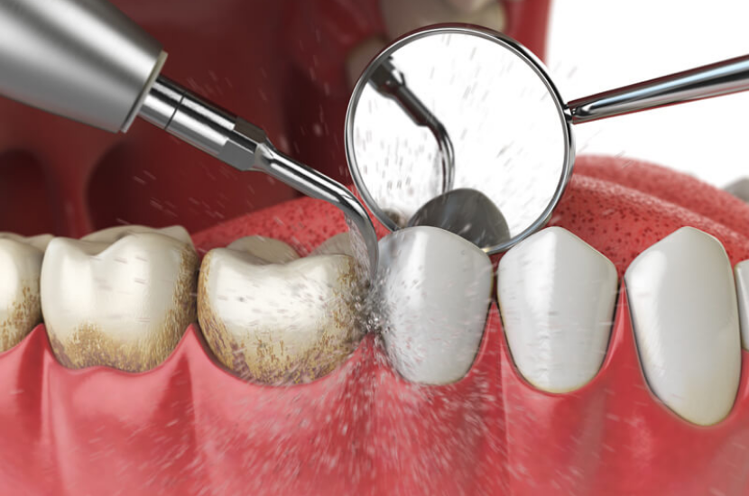 Periodontic Treatment