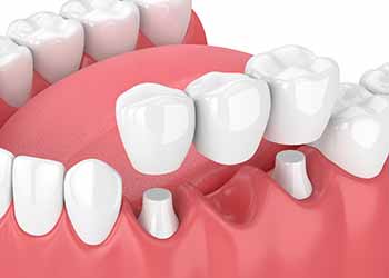 Prosthodontic Treatment