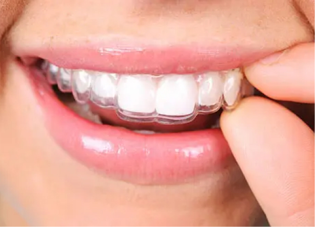 Clear Aligners